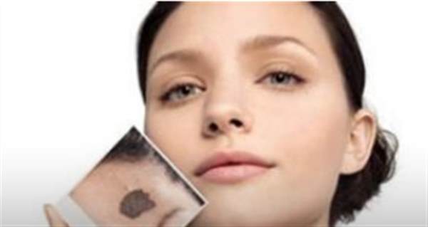 如何去除臉上黑胎記