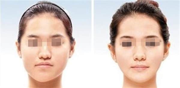 發際線一般多少錢