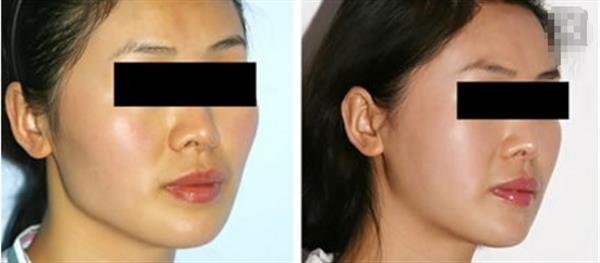 <a href=http://m.f3bb6.cn/listinfo-632-0.html target=_blank class=infotextkey>正頜</a>手術需要多少錢