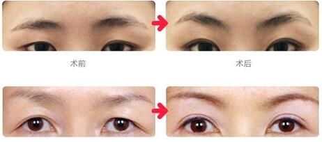 杭州韓式提眉術的優勢有哪些