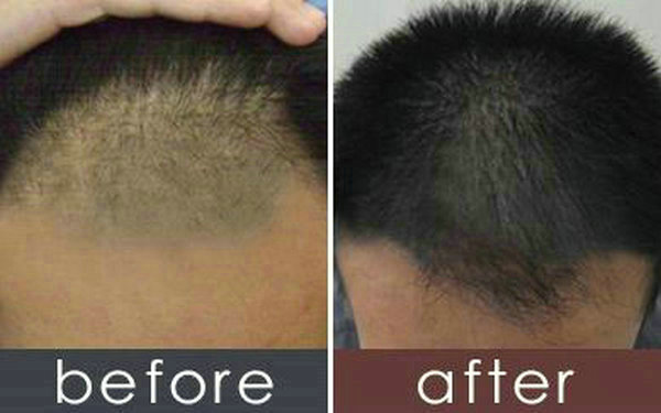 哪些人不適合植發(fā)?