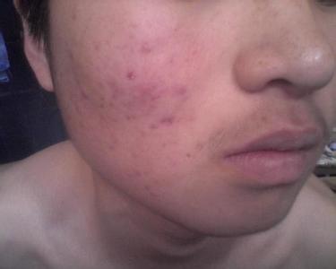 激光去痘坑副作用