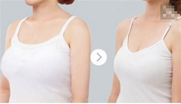 乳房縮小術價格