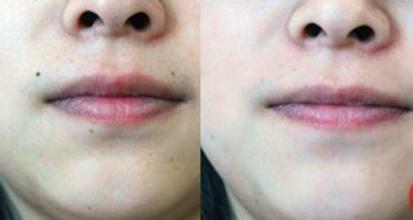 激光<a href=http://m.f3bb6.cn/listinfo-767-0.html target=_blank class=infotextkey>祛痣</a>多久能恢復(fù)