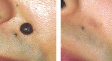 激光點痣疤痕多久能好