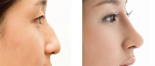 做假體<a href=http://m.f3bb6.cn/listinfo-737-0.html target=_blank class=infotextkey>隆鼻</a>手術痛嗎