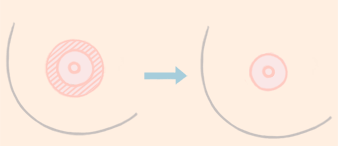 <a href=http://m.f3bb6.cn/listinfo-625-0.html target=_blank class=infotextkey>乳暈縮小</a>手術(shù)的注意事項