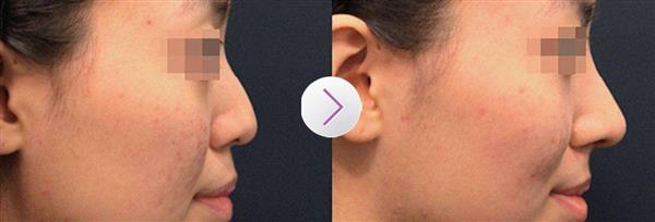 假體<a href=http://m.f3bb6.cn/listinfo-737-0.html target=_blank class=infotextkey>隆鼻</a>究竟能夠維持多長時間呢