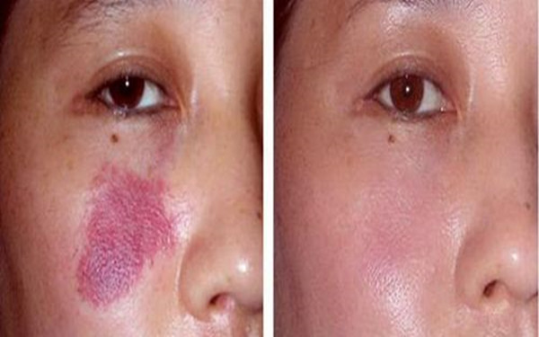 廣州<a href=http://m.f3bb6.cn/listinfo-773-0.html target=_blank class=infotextkey>去胎記</a>價(jià)格