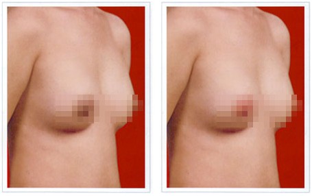 乳頭縮小手術效果好嗎？