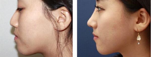 假體<a href=http://m.f3bb6.cn/listinfo-737-0.html target=_blank class=infotextkey>隆鼻</a>后多久消腫