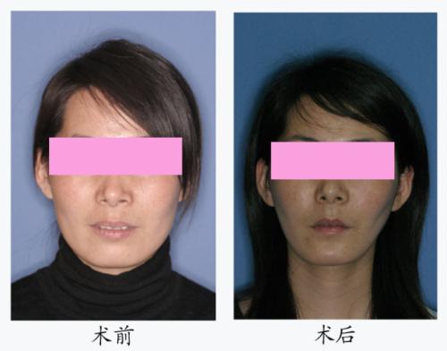 <a href=http://m.f3bb6.cn/listinfo-632-0.html target=_blank class=infotextkey>正頜</a>手術費用多少