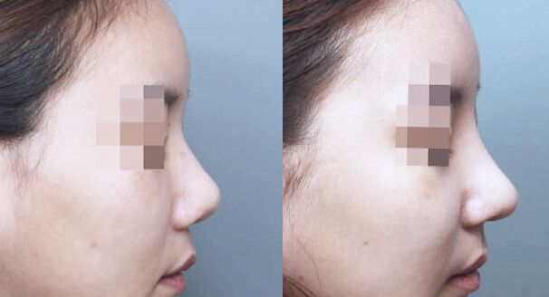 硅膠<a href=http://m.f3bb6.cn/listinfo-737-0.html target=_blank class=infotextkey>隆鼻</a>效果可以長期維持嗎