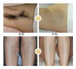 冰點<a href=http://m.f3bb6.cn/listinfo-670-0.html target=_blank class=infotextkey>脫毛</a>的危害