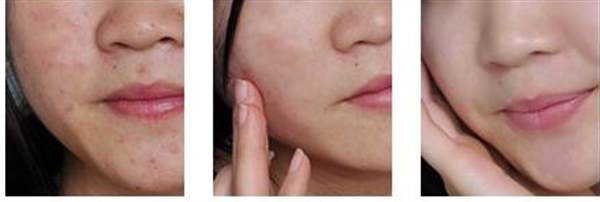 閉口粉刺怎么去除