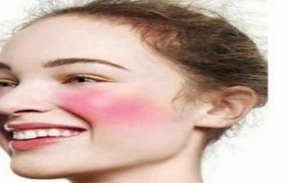 治紅血絲需要多少錢