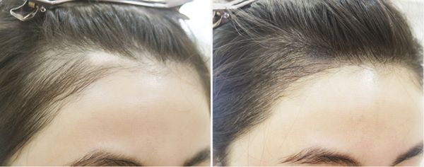 發(fā)際線種植術(shù)價格