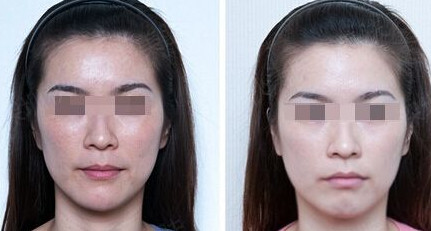 光子<a href=http://m.f3bb6.cn/listinfo-770-0.html target=_blank class=infotextkey>嫩膚</a>后可以洗臉嗎