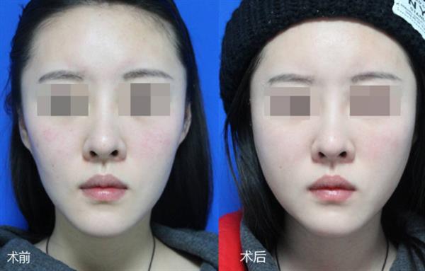 光子<a href=http://m.f3bb6.cn/listinfo-770-0.html target=_blank class=infotextkey>嫩膚</a>會給肌膚帶來什么樣的效果