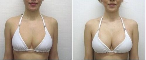 乳房過大會(huì)影響身體健康嗎