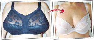 乳房縮小的手術過程詳解