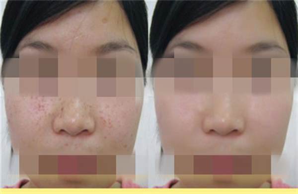 雀斑能不能治療？