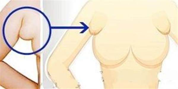 副乳去除多少錢