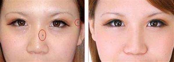 co2點痣和激光點痣區別