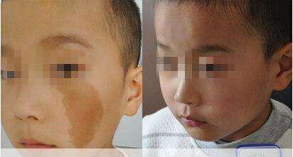 E光治療鮮紅斑痣的副作用有哪些呢