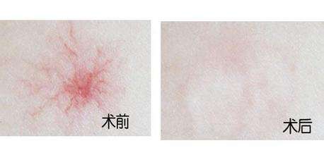 上海激光治療蜘蛛痣貴不貴