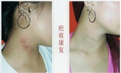 疤克治療疤痕增生嗎