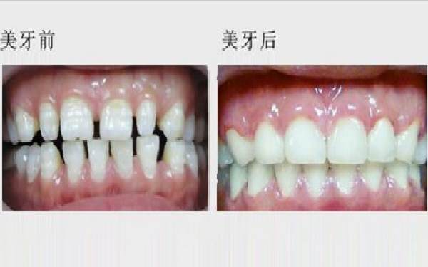 <a href=http://m.f3bb6.cn/listinfo-830-0.html target=_blank class=infotextkey>美容冠</a>前后對(duì)比