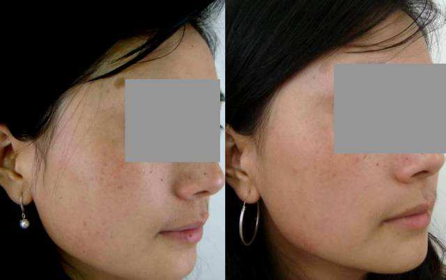 激光治療蜘蛛痣后多久才能碰水