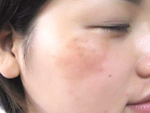 C6激光<a href=http://m.f3bb6.cn/listinfo-786-0.html target=_blank class=infotextkey>去黃褐斑</a>價格一般是多少