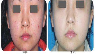 上海激光治療蜘蛛痣價格是多少