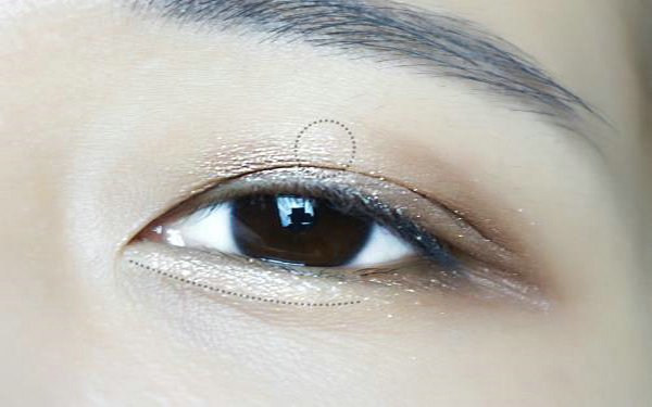 韓式小切口是埋線嗎