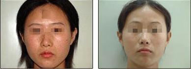 激光治療蜘蛛痣手術會不會反彈