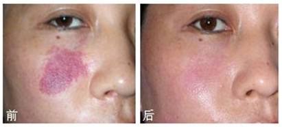激光治療蜘蛛痣優點有哪些
