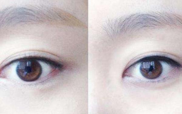 <a href=http://m.f3bb6.cn/listinfo-690-0.html target=_blank class=infotextkey>自體脂肪填充</a>能變<a href=http://m.f3bb6.cn/listinfo-722-0.html target=_blank class=infotextkey>臥蠶</a>眼嗎