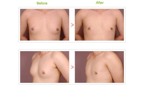 男性乳房肥大該如何治療