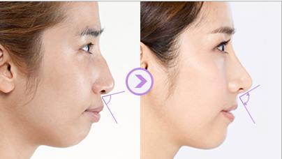 哪些人不能做突嘴手術(shù)?