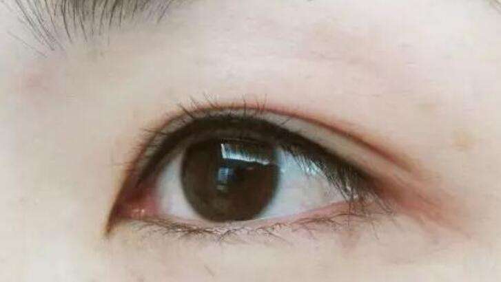 <a href=http://m.f3bb6.cn/listinfo-705-0.html target=_blank class=infotextkey>美瞳線</a>后眼睛腫幾天