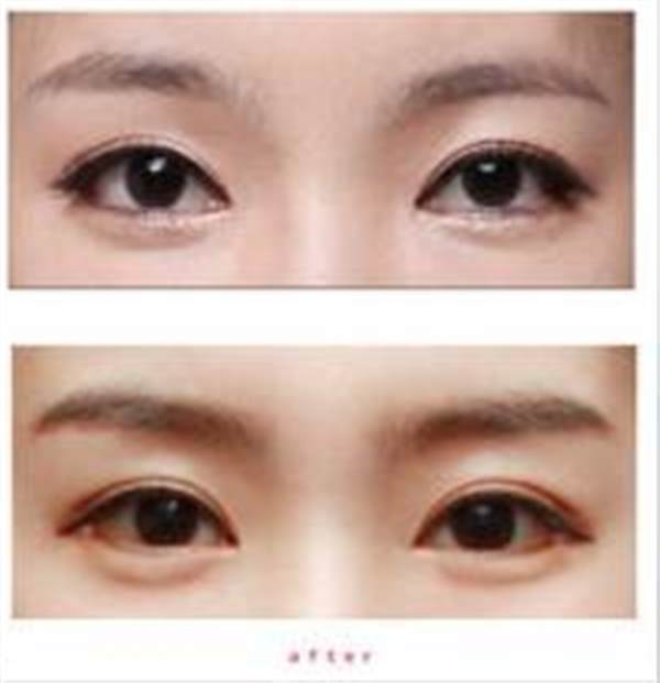 透明質(zhì)酸豐<a href=http://m.f3bb6.cn/listinfo-722-0.html target=_blank class=infotextkey>臥蠶</a>對(duì)會(huì)傷害眼角膜嗎