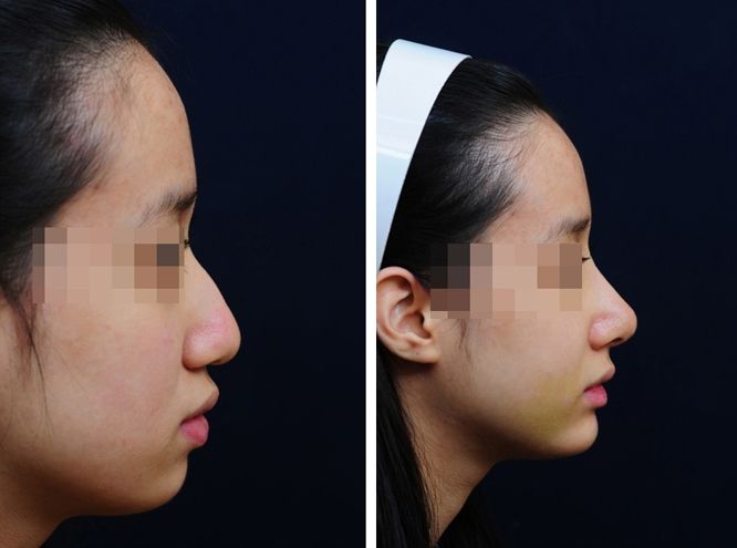 到底膨體好還是硅膠好