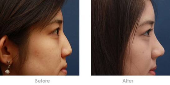 <a href=http://m.f3bb6.cn/listinfo-737-0.html target=_blank class=infotextkey>隆鼻</a>膨體感染的癥狀