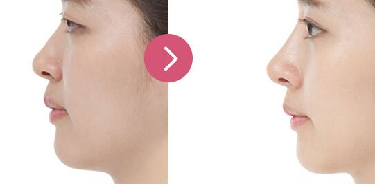 做完膨體<a href=http://m.f3bb6.cn/listinfo-737-0.html target=_blank class=infotextkey>隆鼻</a>多久消腫