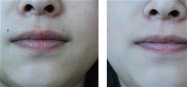 激光去痣好不好呢