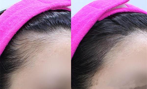 發(fā)際線后移怎么辦呢