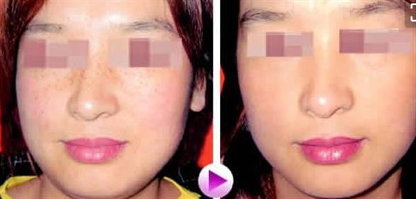 治療雀斑方法知多少