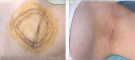 狐臭激光治療多少錢